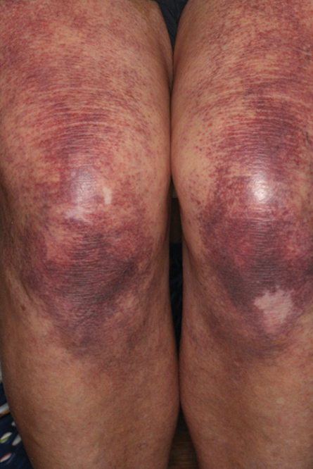 Modest improvement in cutaneous collagenous vasculopathy was noted on the legs after pulsed dye laser therapy for 3 years.