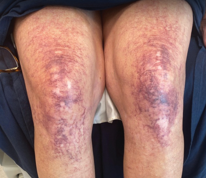 The addition of sclerotherapy to pulsed dye laser therapy showed a decrease in telangiectases and smaller patches after 2 years.