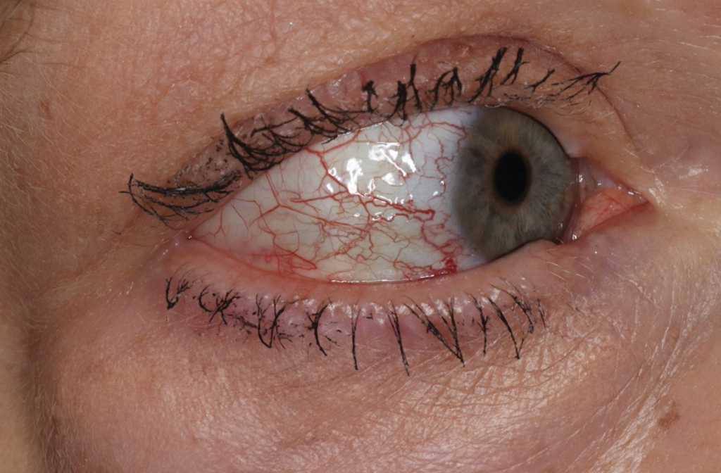 Cutaneous collagenous vasculopathy eye involvement with dilations, beading, and tortuosity of superficial scleral and episcleral vessels, along with vessels on the palpebral conjunctiva.