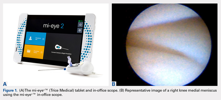 (A) The mi-eye+TM (Trice Medical) tablet in-office scope. (B) Representative image of a right knee medial meniscus using the mi-eye+TM in-office scope.