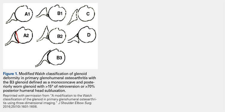 Modified Walch classification of glenoid deformity in primary glenohumeral osteoarthritis with the B3 glenoid defined as a monoconcave ad posteriorly worn glenoid