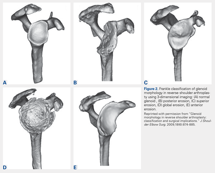 Frankle classification of glenoid morphology in reverse shoulder arthroplasty using 3-dimensional imaging