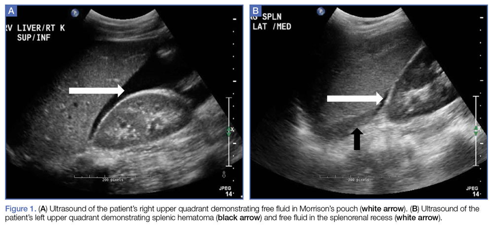 Abnormal Spleen Ultrasound