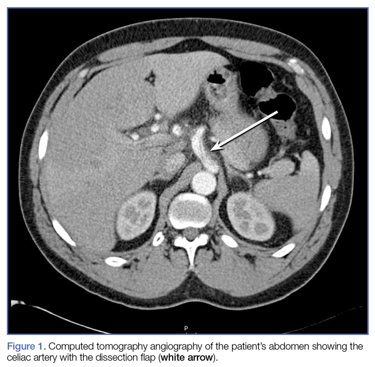 celiac artery cat