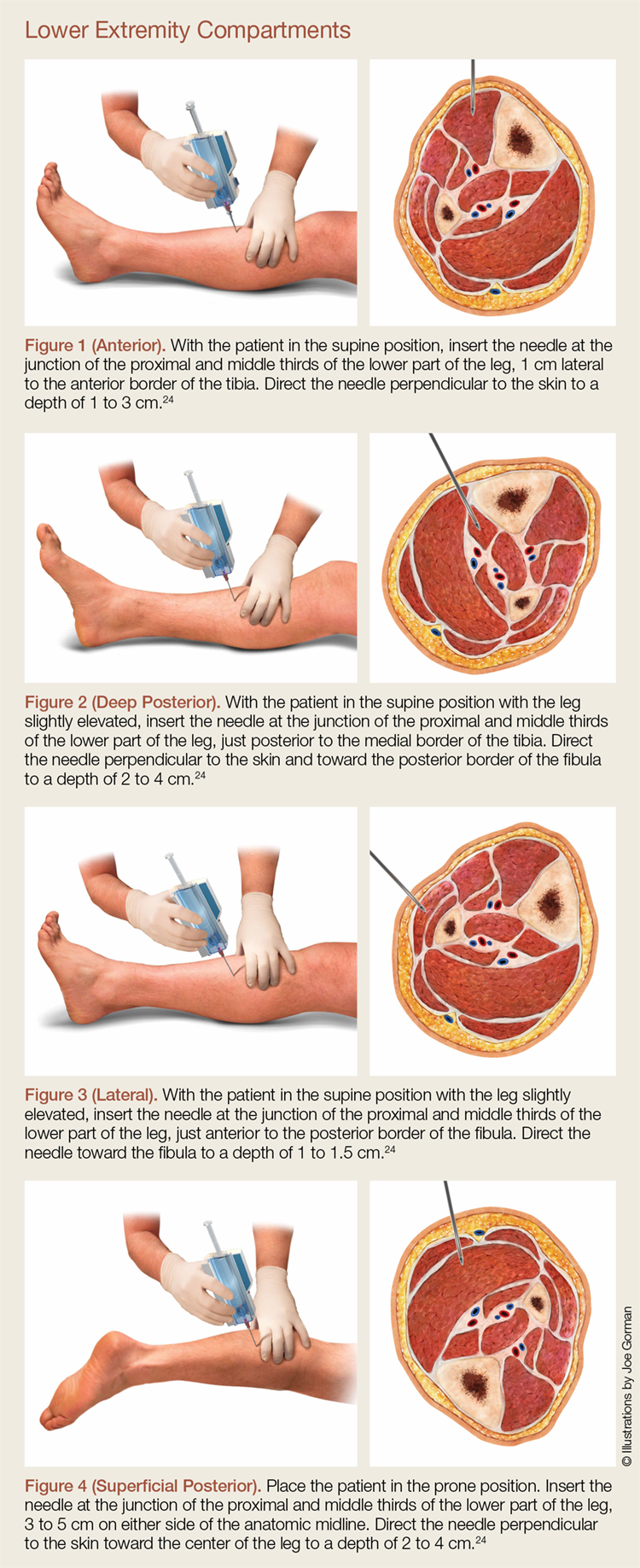 lower extremity compartments fasciotomy