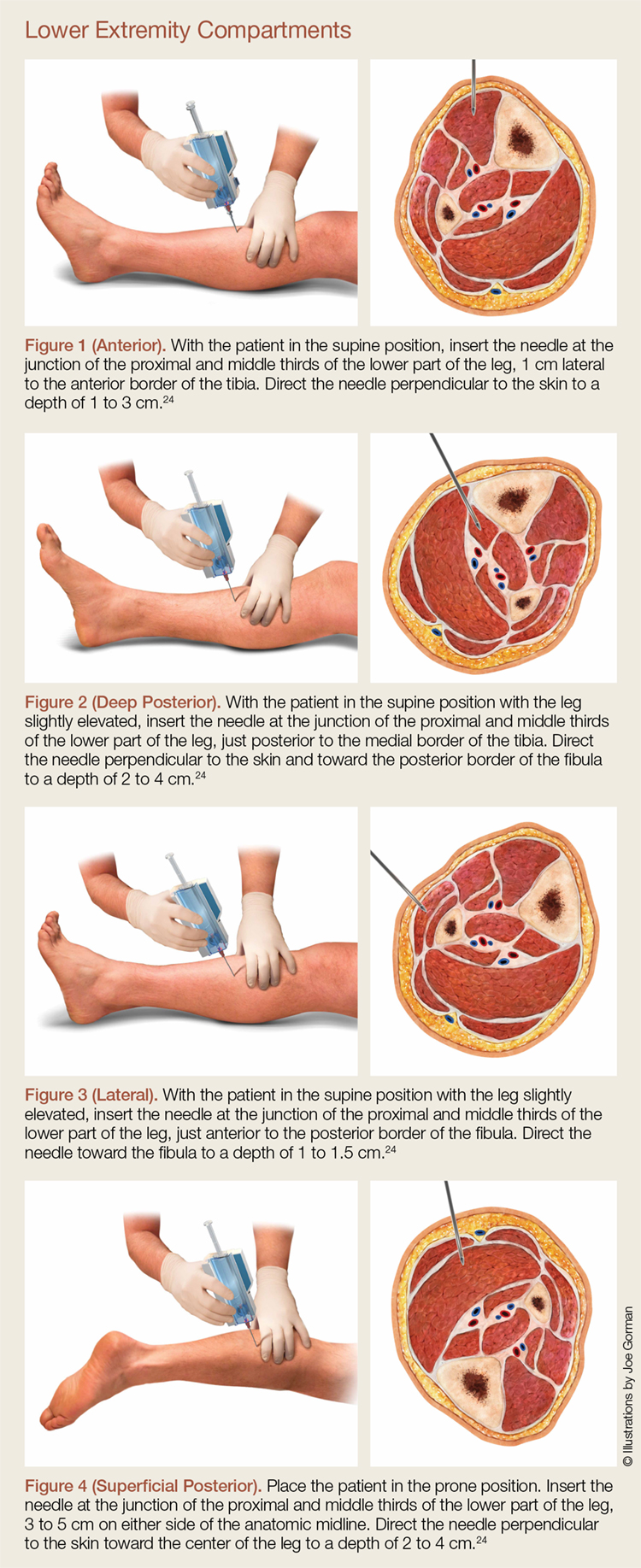 Compartment syndrome of the lower leg