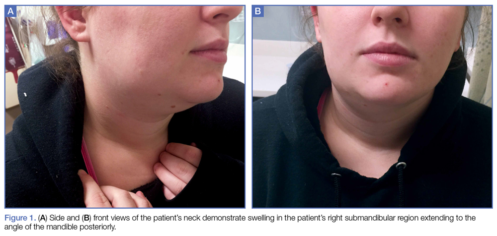 Acute Submandibular Sialadenitis MDedge Emergency Medicine