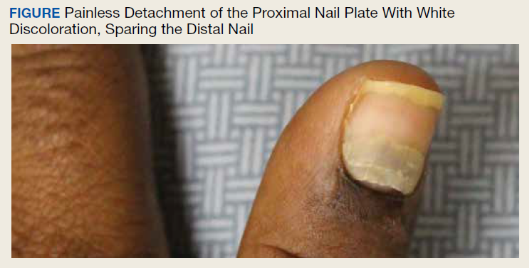 Image: Nail Discoloration Due to Nail Polish - MSD Manual Consumer Version