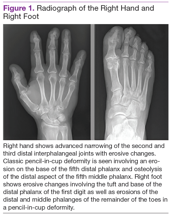 psoriatic arthritis feet