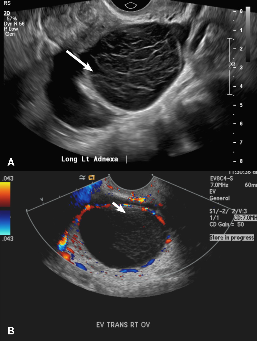 How Bleeding Ovarian Cysts Look On Transvaginal Ultrasound | My XXX Hot ...