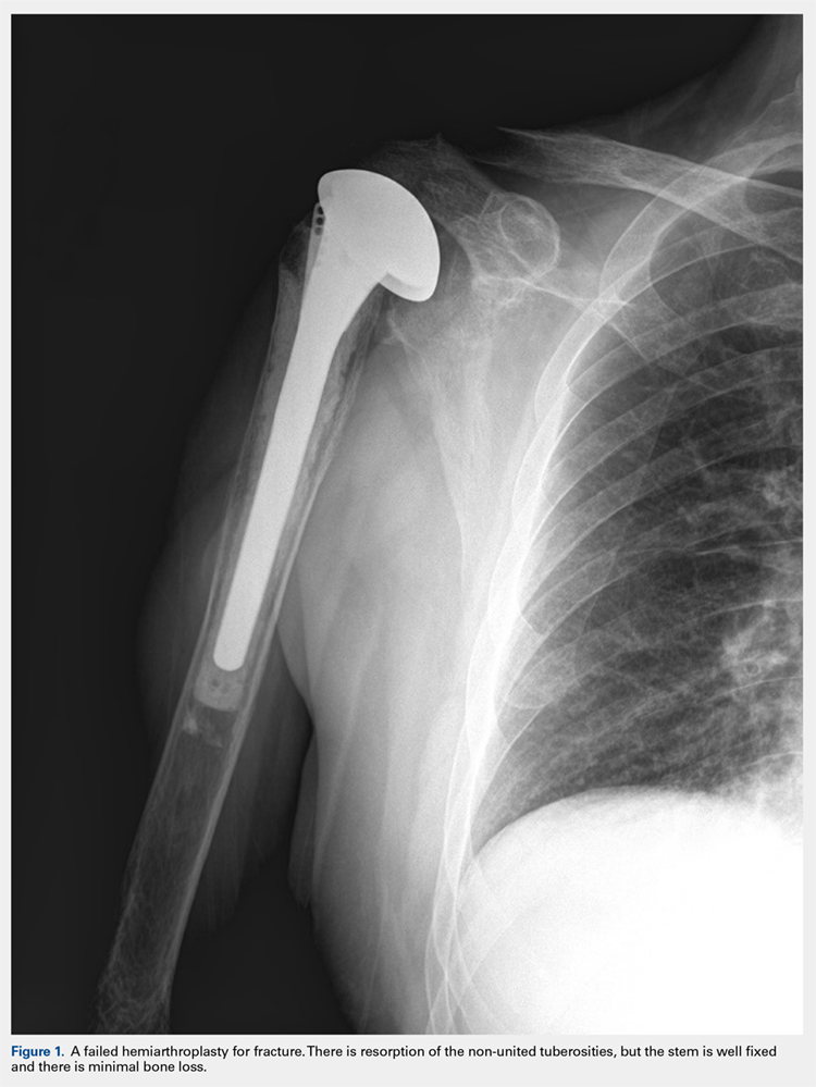 A failed hemiarthroplasty for fracture