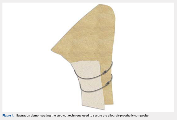 Illustration demonstrating the step-cut technique used to secure the allograft-prosthetic composite