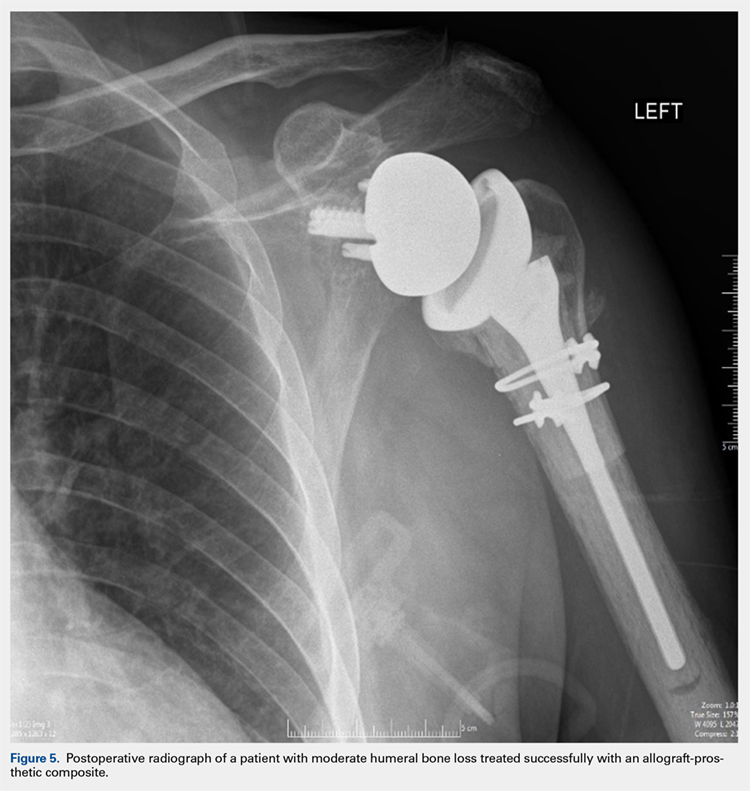 Postoperative radiograph of a patient with moderate humeral bone loss treated successfully with an allograft-prosthetic composite