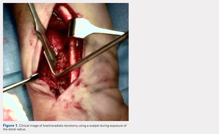 Clinical image of brachioradialis tenotomy using a scalpel during exposure of the distal radius