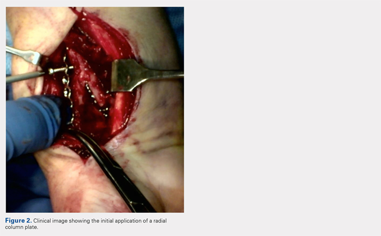 Clinical image showing the initial application of a radial column plate