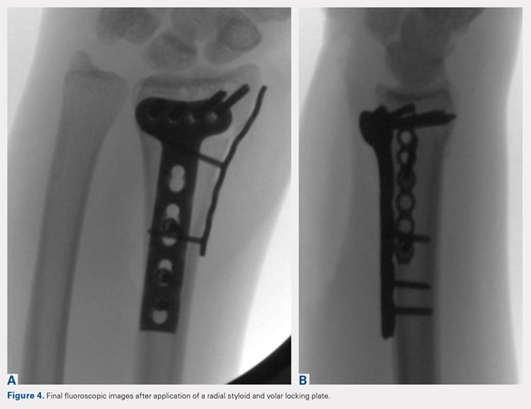 Final fluoroscopic images after application of a radial styloid and volar locking plate