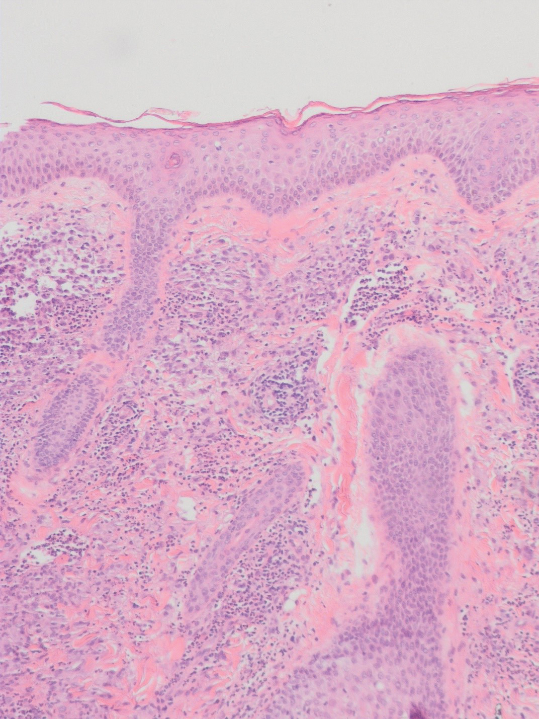 Histopathologic examination showed a diffuse, dense, mixed inflammatory cellular infiltrate with numerous neutrophils and eosinophils with leukocytoclasia, sparing the subepidermal area, forming a grenz zone