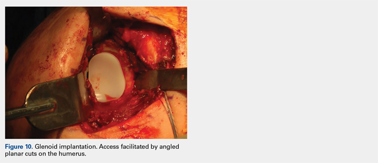 Glenoid implantation. Access facilitated by angled planar cuts on the humerus.