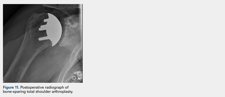 Postoperative radiograph of bone-sparing total shoulder arthroplasty.