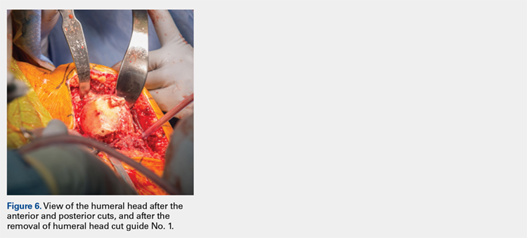 View of the humeral head after the anterior and posterior cuts, and after the removal of humeral head cut guide No. 1.