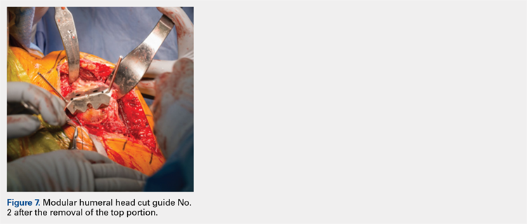 Modular humeral head cut guide No. 2 after the removal of the top portion.