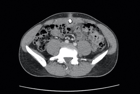 Axial intravenous contrast-enhanced computed tomography revealed inflammation surrounding the umbilicus with an associated 1-cm calcification.