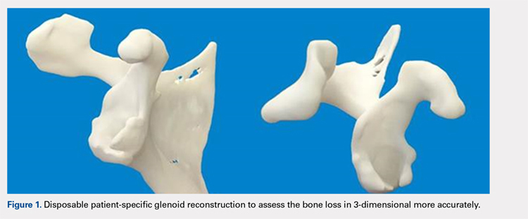 Disposable patient-specific glenoid reconstruction to assess the bone loss in 3-dimensional more accurately.