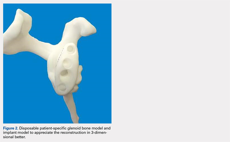 Disposable patient-specific glenoid bone model and implant model to appreciate the reconstruction in 3-dimensional better.