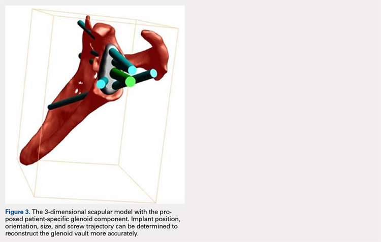 The 3-dimensional scapular model with the proposed patient-specific glenoid component. Implant position, orientation, size, and screw trajectory can be determined to reconstruct the glenoid vault more accurately.