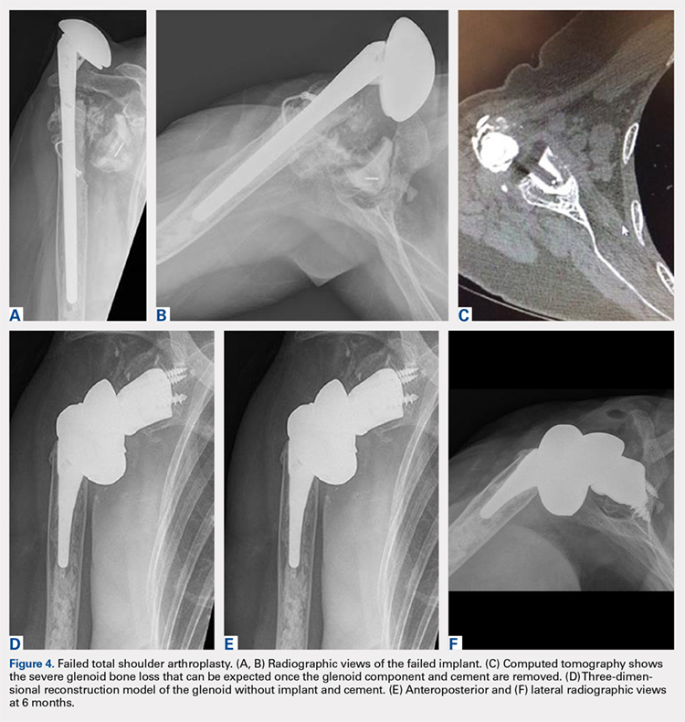 Failed total shoulder arthroplasty