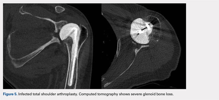 Infected total shoulder arthroplasty. Computed tomography shows severe glenoid bone loss.