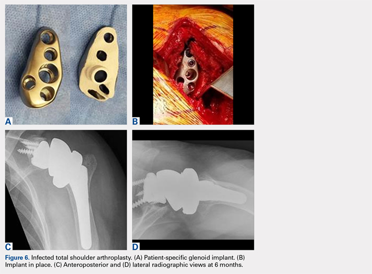 Infected total shoulder arthroplasty