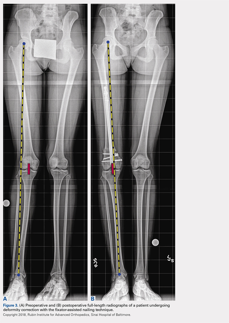 Periprosthetic supracondylar femoral fractures following total knee  arthroplasty: clinical comparison and related complications of the femur  plate system and retrograde-inserted supracondylar nail | Journal of  Orthopaedics and Traumatology | Full Text