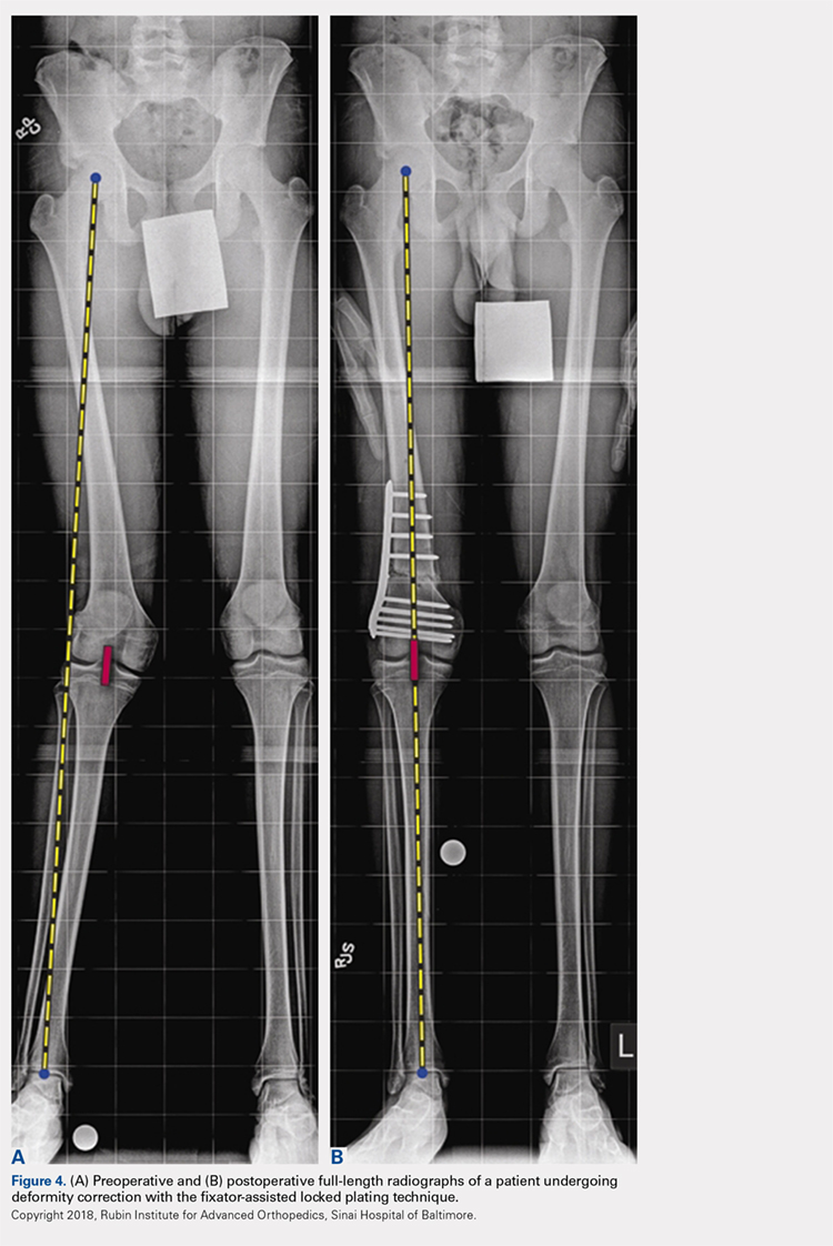 Current Concepts in Paediatric Femoral Shaft Fractures