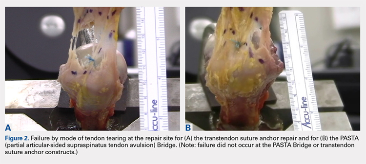 Failure by mode of tendon tearing at the repair site