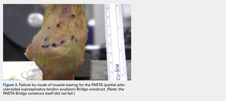 Failure by mode of muscle tearing for the PASTA