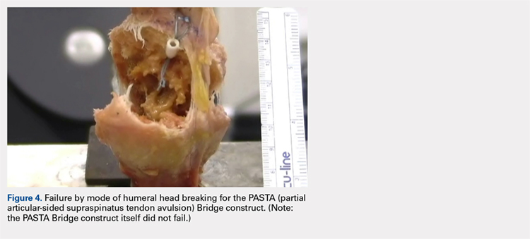 Failure by mode of humeral head breaking for the PASTA bridge construct