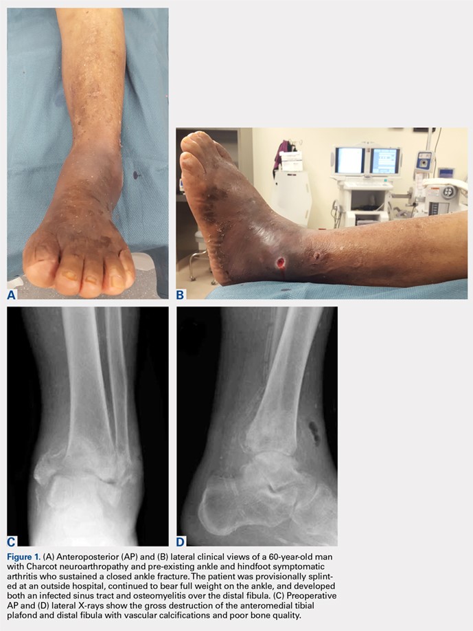 Complex Ankle and Hindfoot Arthrodesis 