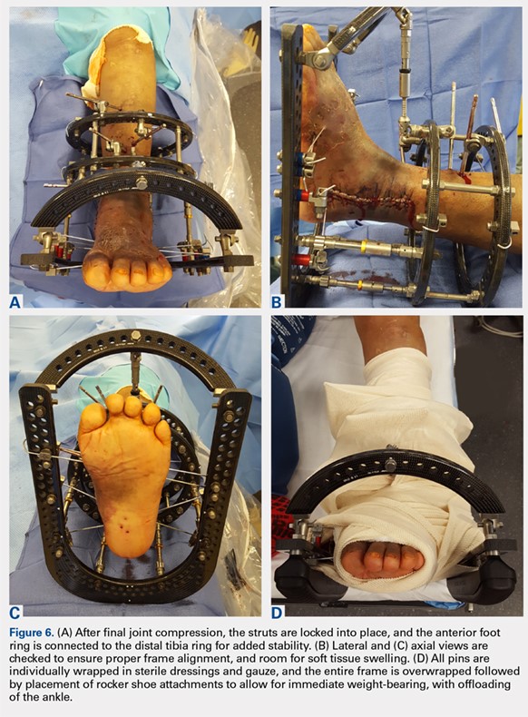 Pilfer date Colleague Complex Ankle and Hindfoot Arthrodesis Using Circular External Fixation |  MDedge Surgery