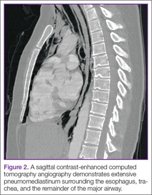 Case Report: Sudden Chest Pain Following an Asthma Attack | MDedge ...