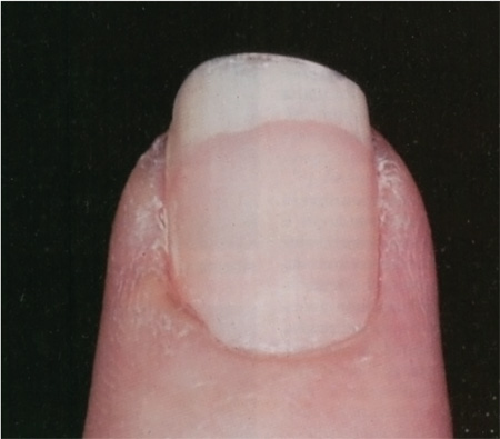 An Ophthalmic Screening Protocol for Nail-Patella Syndrome | Journal of  Pediatric Ophthalmology & Strabismus