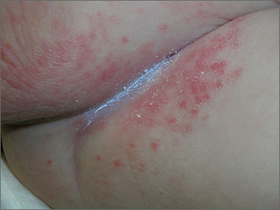 Thrush Diaper Rash  : Addressing Symptoms and Prevention