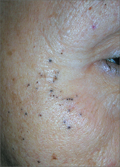 Black spots on both sides of face | MDedge Family Medicine