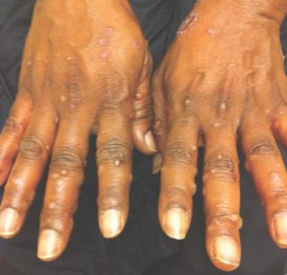 Figure 1. Papules, vesicles, and crusts on the dorsal surfaces of both hands in a 52-year-old black woman. 