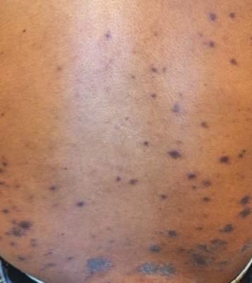 Figure 2. Lesions on the back that resolved after 2 weeks with postinflammatory hyperpigmentation. 