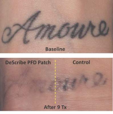 Gel patch speeds laser tattoo removal  MDedge Dermatology