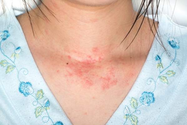 Can Cancer Cause A Rash On Your Neck