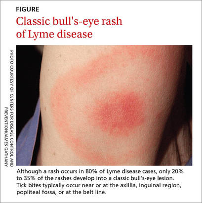Beyond the bull's eye: Recognizing Lyme disease | Clinician Reviews