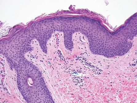 Figure 6. Parakeratotic scale with underlying interface dermatitis, prominent lymphocytic exocytosis, and lymphocytic vasculitis in pityriasis lichenoides et varioliformis acuta (H&E, original magnification ×200).
