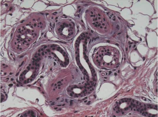 Figure 4. Eccrine sweat gland with normal secretory coils and excretory ducts. No inflammation or syringosquamous metaplasia were noted (H&E, original magnification ×20). 